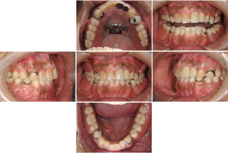 歯がボロボロになってしまった方の回復した症例（術後）